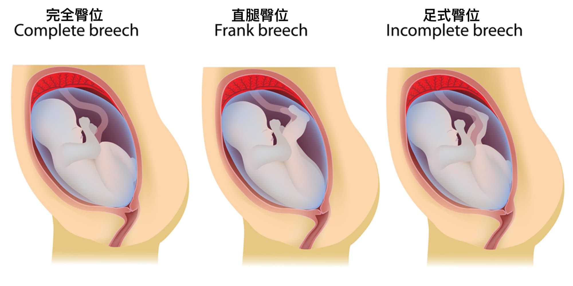 胎兒胎位不正有分3大類