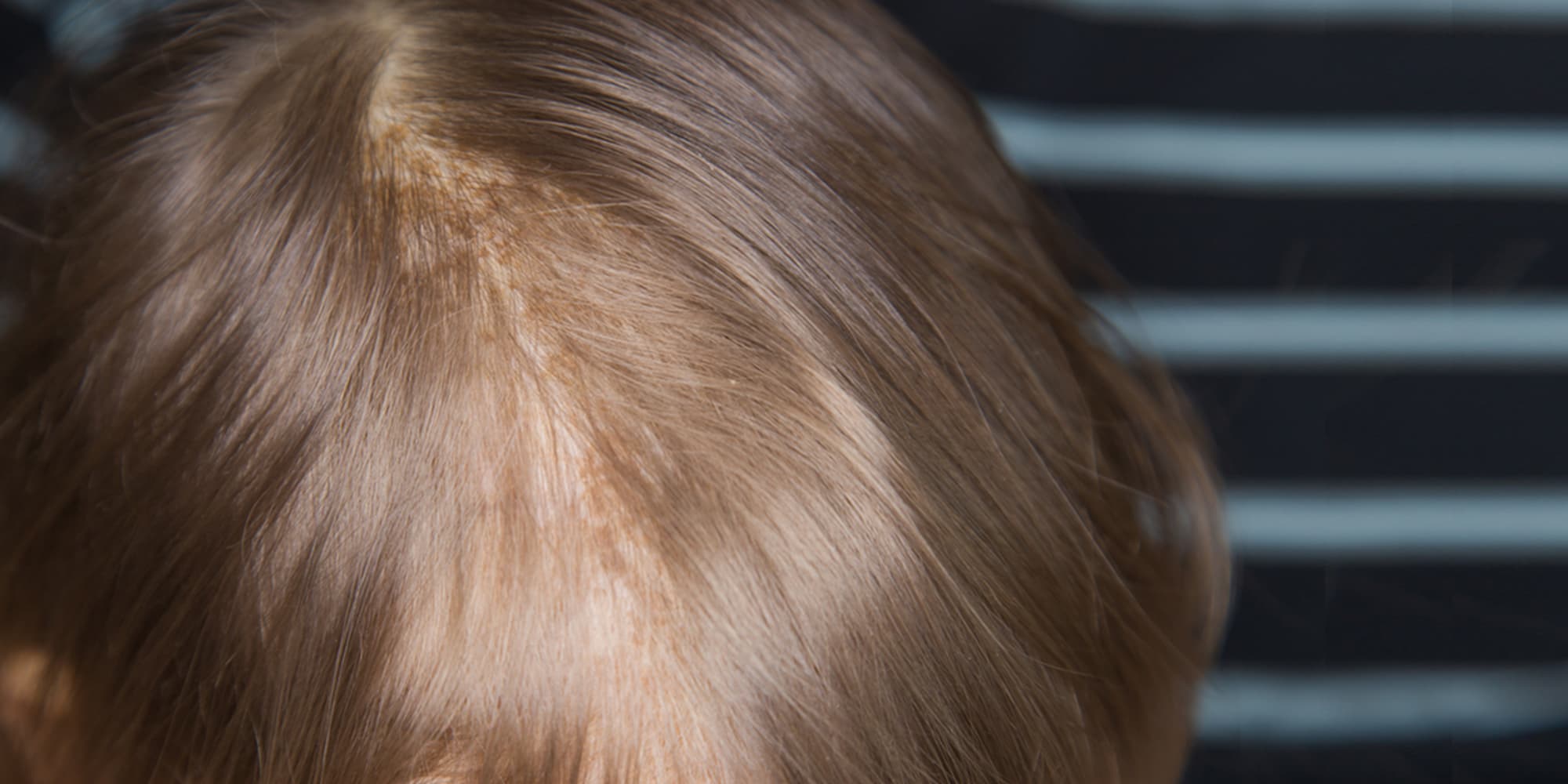 嬰兒脂漏性皮膚炎